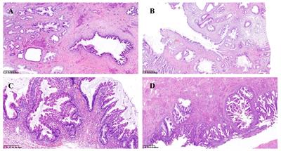 Synchronous mucinous metaplasia and neoplasia of the female genital tract with both pulmonary metastases and STK11/KRAS gene mutations: a case report